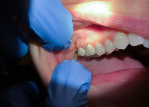 Best Emergency Dentist for Lost Fillings or Crowns in Exeter, PA